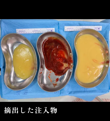 摘出した注入物