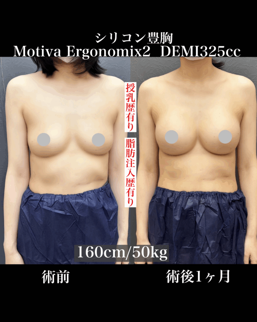 豊胸シリコンバック