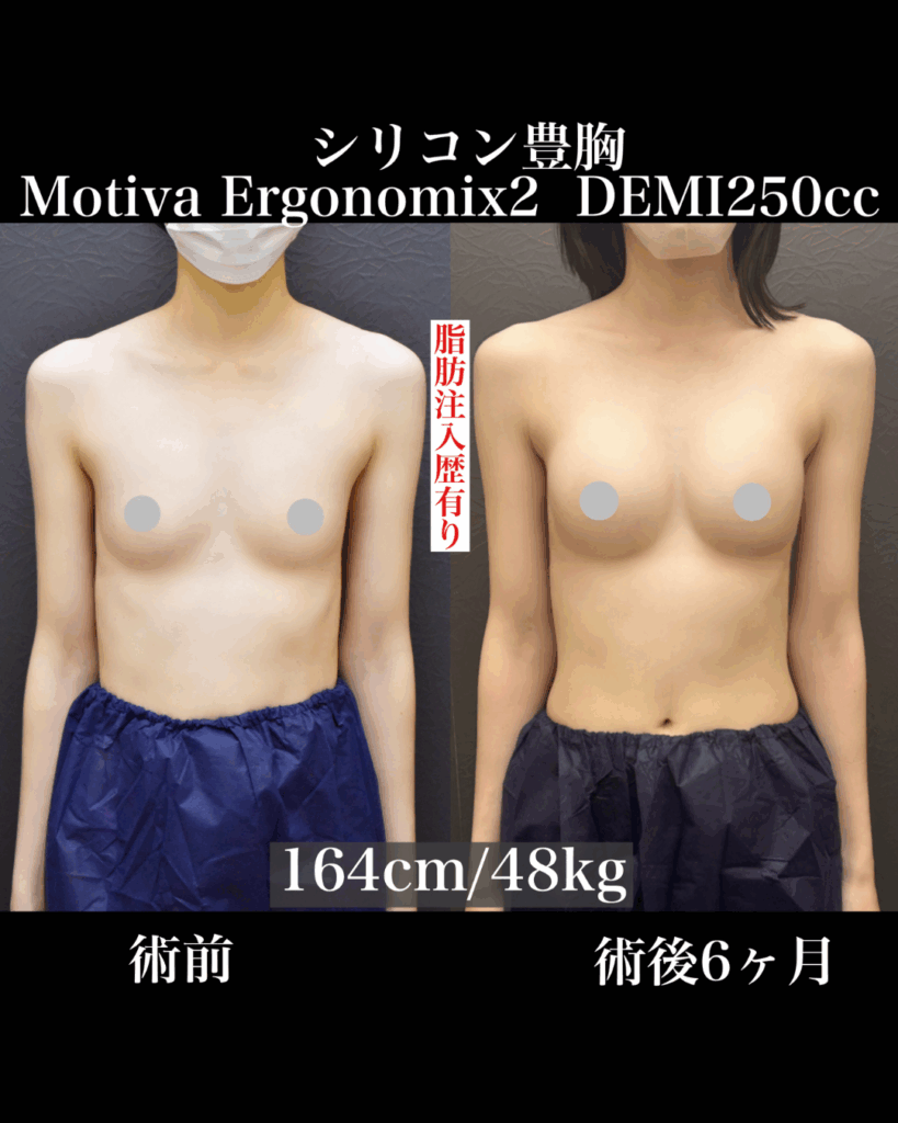 豊胸シリコンバック
