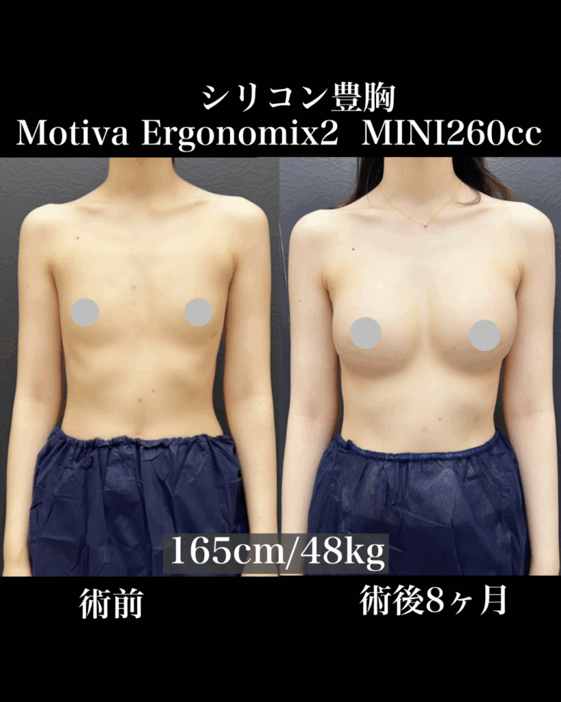 豊胸シリコンバック