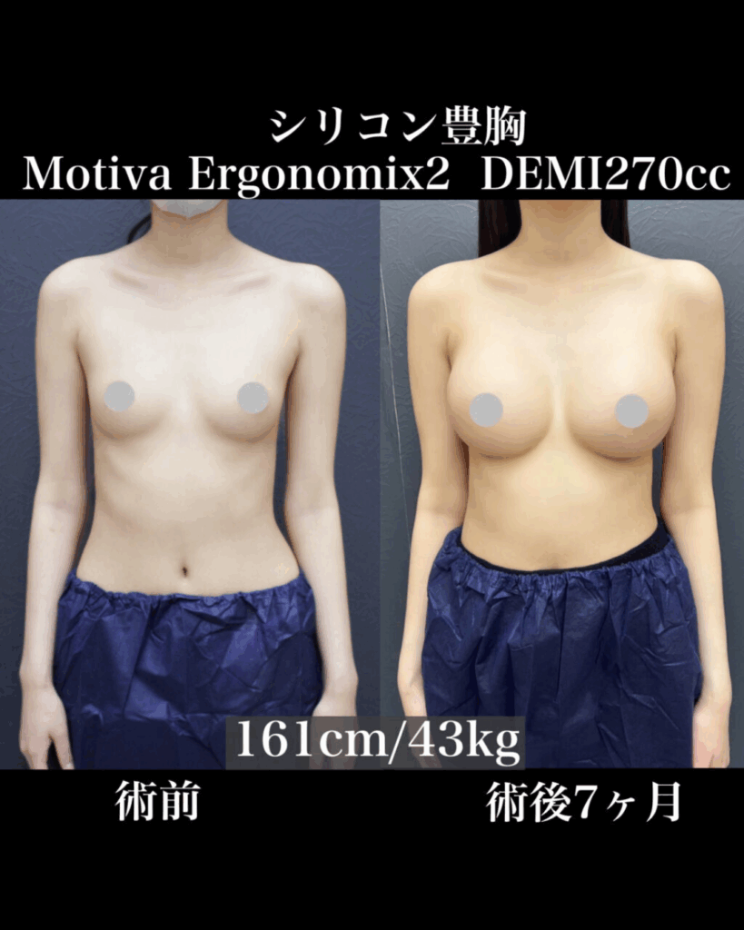 豊胸シリコンバック