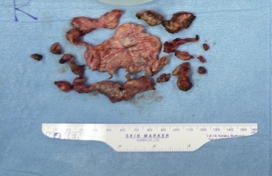 グレードⅣのカプセル拘縮で摘出された被膜組織 石灰化を伴う厚い被膜