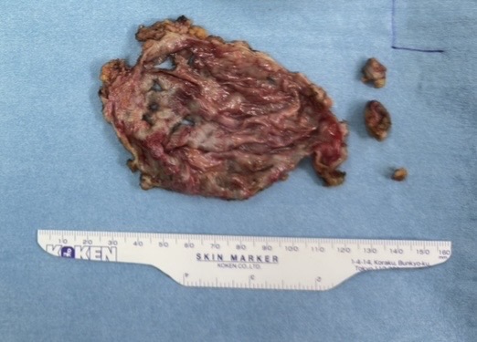 カプセル拘縮により摘出された被膜組織