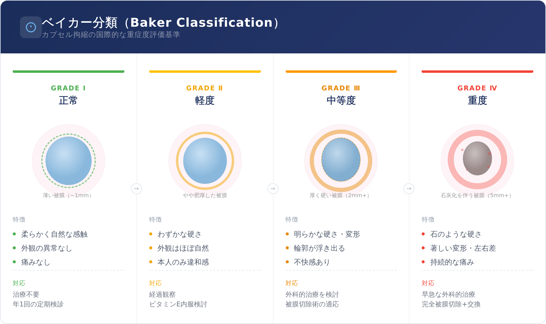 ベイカー分類（Baker Classification）グレードⅠ〜Ⅳの図解 カプセル拘縮の重症度評価